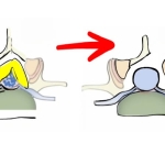 Dar Kanal: Sinsi İlerleyen ve Yürümeyi Güçleştiren Hastalık