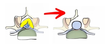 Dar Kanal: Sinsi İlerleyen ve Yürümeyi Güçleştiren Hastalık
