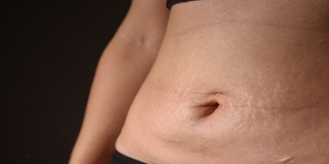 Karın Germe Ameliyatında Yeni Dönem: Op. Dr. Gökhan Semerci ile Doğal, Estetik ve Güvenli Sonuçlar